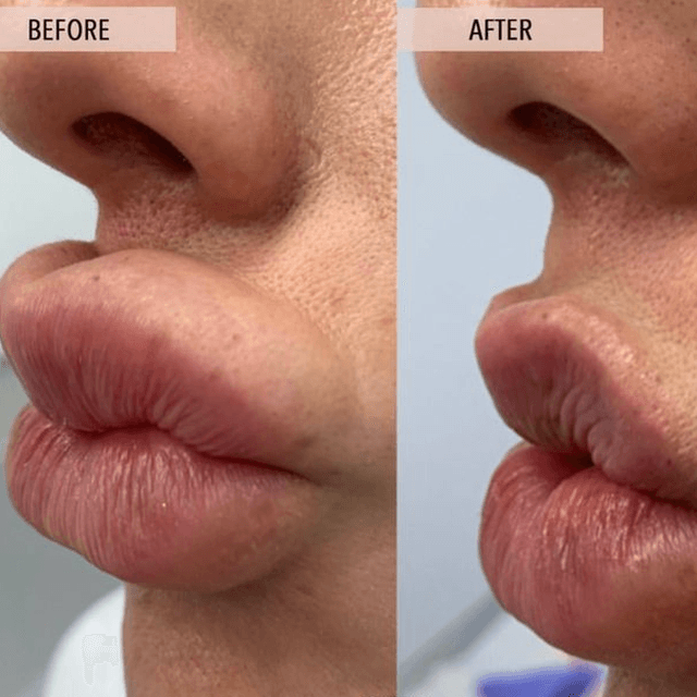 Lip Filler Rehab